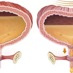 İnterstisyel Sistit Hidrodistansiyon Tedavisi